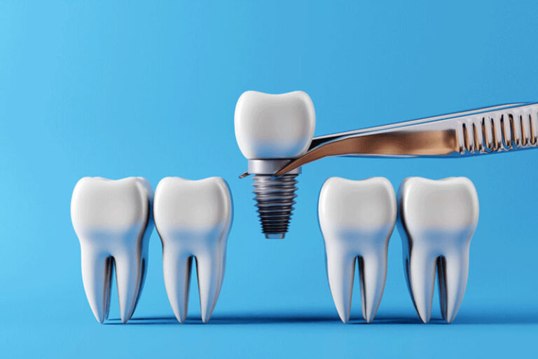 Your Comprehensive Guide on Dental Implants The Best Replacement of Tooth Solution Wickham